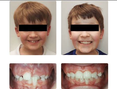 Image result for Crossbite Treatment Options