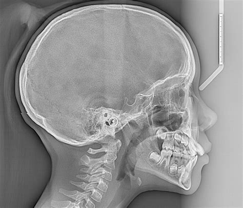 Cephalometric Analysis Based on X-ray Scans | CephX