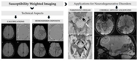 Susceptibility-Weighted Imaging (SWI): Technical Aspects and ...