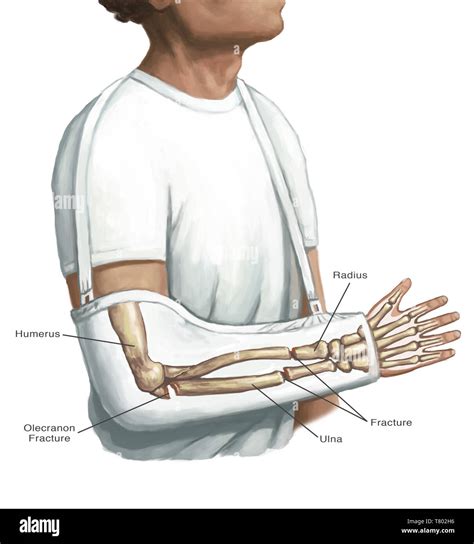 Broken Arm in Cast, Illustration Stock Photo - Alamy
