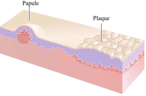 Papule Vs Macule Vs Plaque at Samantha Straus blog