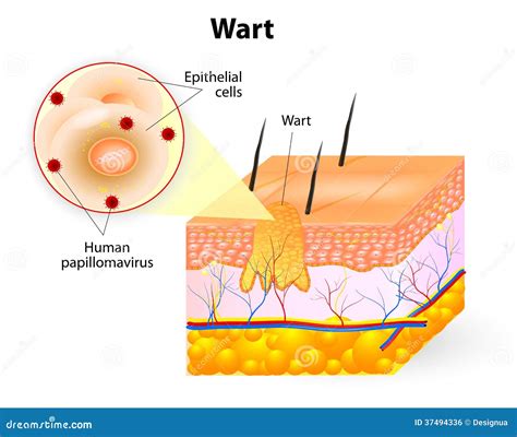 Common Wart Cross Section