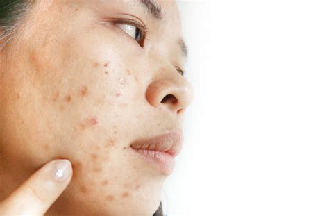 Why You Should Use Natural Products to Remove Hyperpigmentation - Tonique Skincare