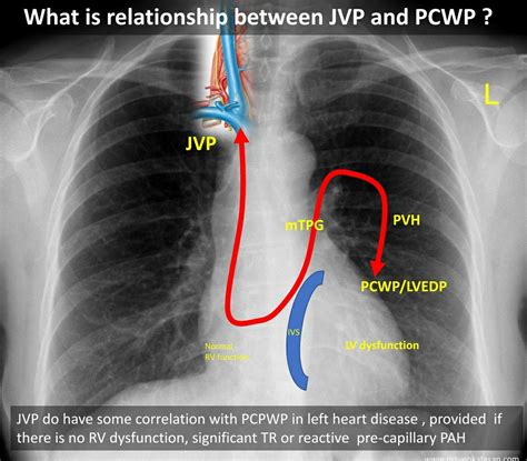 What’s the relationship between JVP and PCWP/LVEDP? | Dr.S.Venkatesan MD