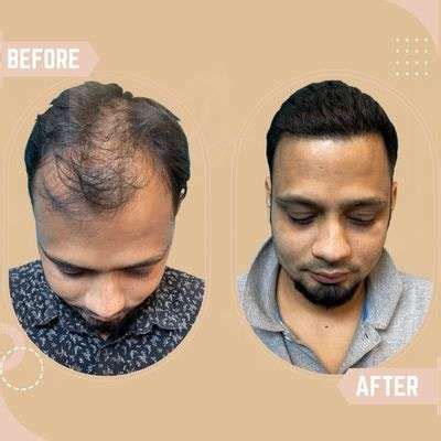 Hair Transplant results