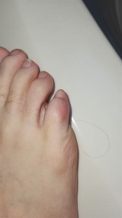 Ran over pinky toe with a shopping cart confirmed hairline fracture : r/medical