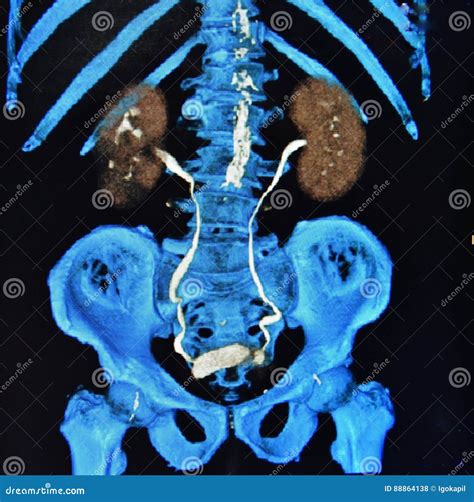 Image result for Urogram CT Scan