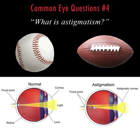 What Is Axis For Astigmatism at David Beach blog