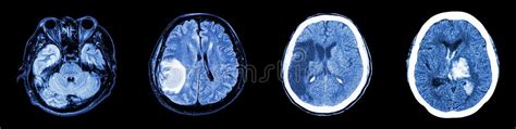 Image result for Normal Brain CT Scan Head