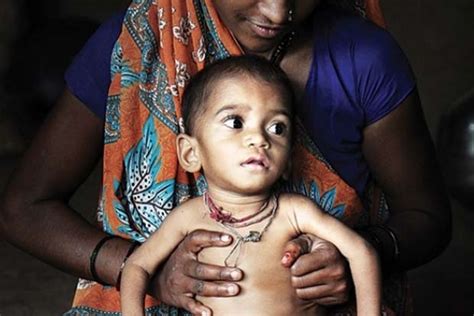 Over 35 percent of Indian kids below 5 years underweight: Study