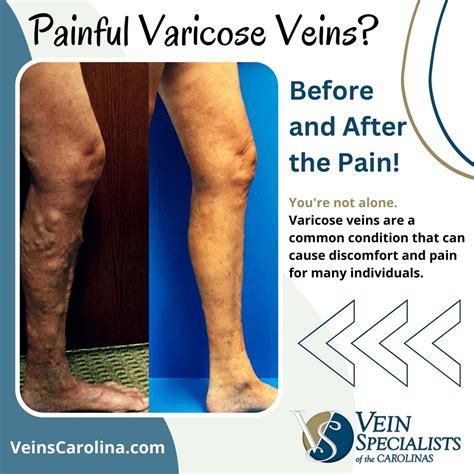 Can Tight Pants Cause Varicose Veins at Adolph Grier blog