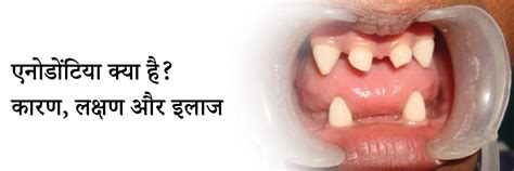 एनोडोंटिया क्या है? कारण, लक्षण और इलाज | What is Anodontia in Hindi