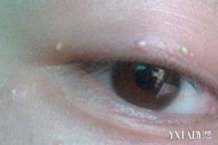 【图】为什么眼睛边上长白色颗粒？ 了解它产生的原因和消除方法_眼睛边上长白色颗粒_伊秀美容网|yxlady.com