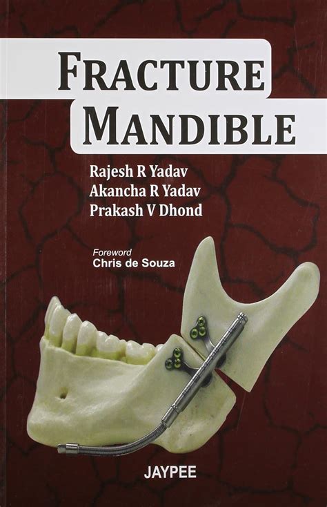 Buy Fracture Mandible Book Online at Low Prices in India | Fracture ...
