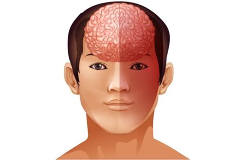 The throbbing headache migraine – The Health Quest