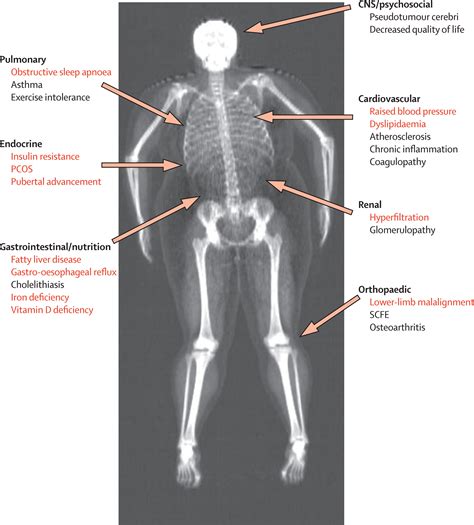 Childhood obesity - The Lancet