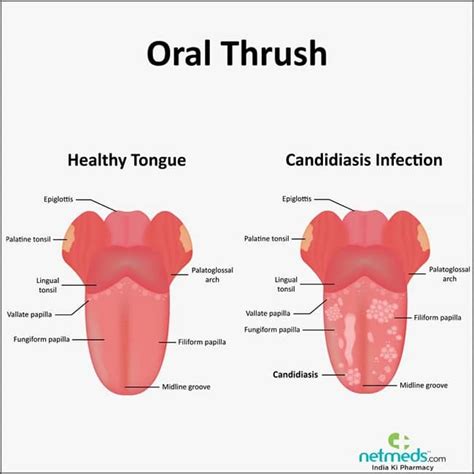 How to prevent oral thrush from antibiotics