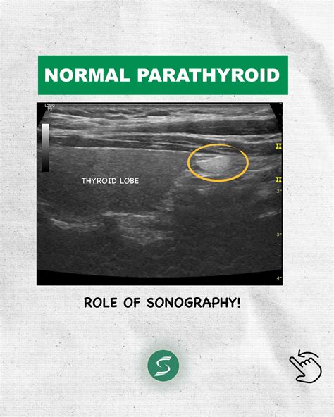 Ultrasound | Education | - Historically, normal parathyroid glands have ...