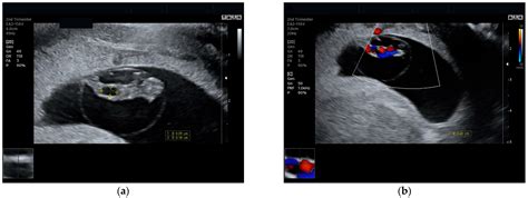 Clinical Significance and Prognosis of Prenatal Diagnosis of Large ...