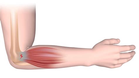 Codo de tenista o epicondinitis lateral - Onlytenis Blog