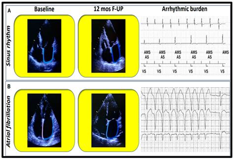 Impact of Percutaneous Mitral Valve Repair on Left Atrial Strain and ...