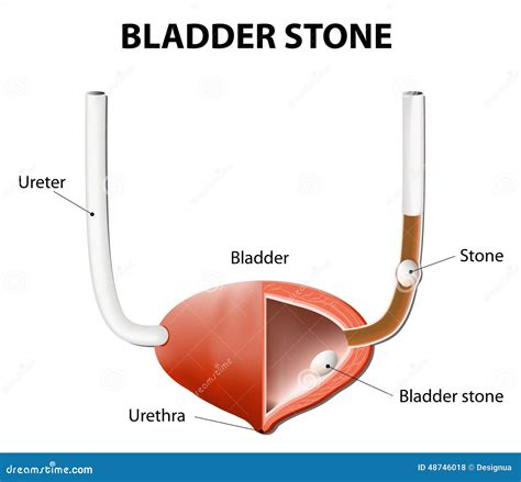 Stones in the Urinary Bladder and Ureter Stock Vector - Illustration of acid, bladder: 48746018