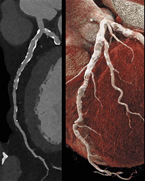 A faster, more accurate way to diagnose heart disease? - Harvard Health