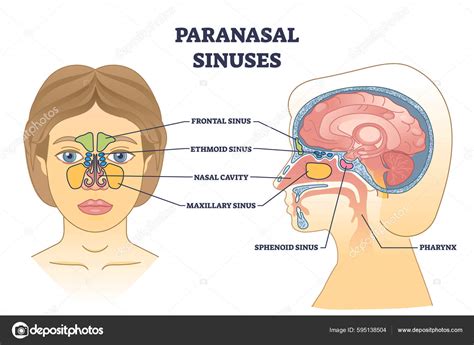 Paranasal Sinuses Sinusitis Information | Mount Sinai New York