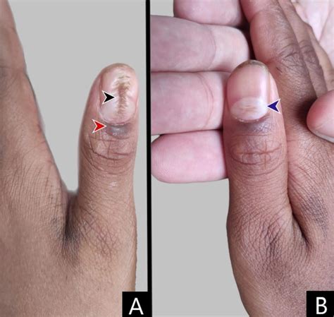 Lichen Planus Nails