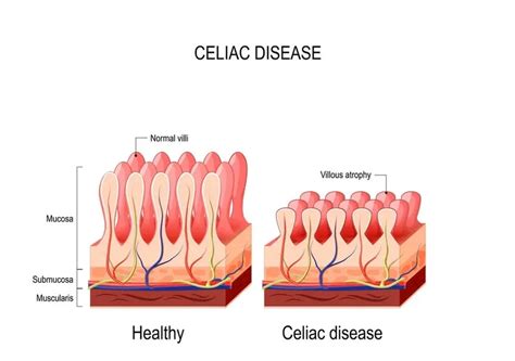 Living with celiac disease- your guide to a gluten-free life