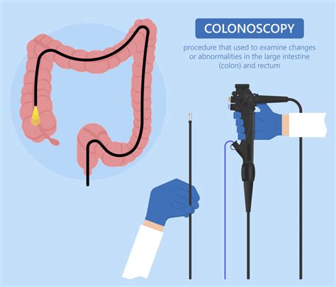 Colonoscopy Process 的图像结果