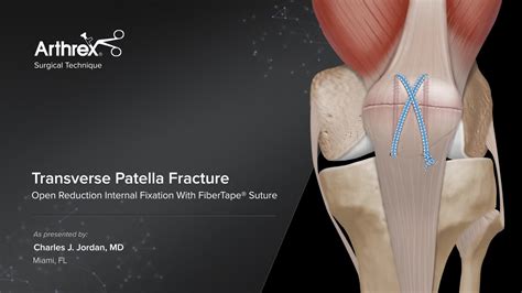 Arthrex - Transverse Patella Fracture Open Reduction Internal Fixation ...
