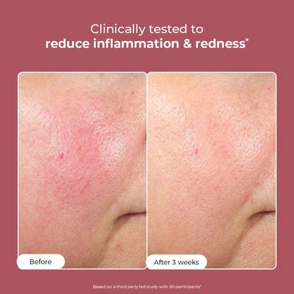 Shop Azicalm Redness & Inflammation Relief Cream | 10% Azelaic Acid ...