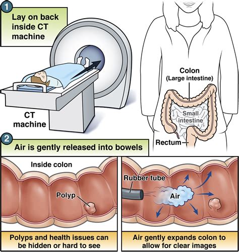 CT colonography - AGA GI Patient Center