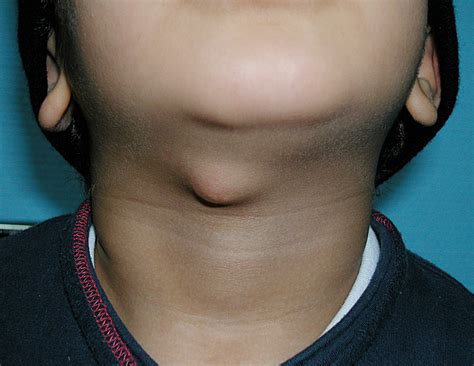 Thyroglossal Duct Cyst – Pictures, Symptoms, Treatment and Surgery