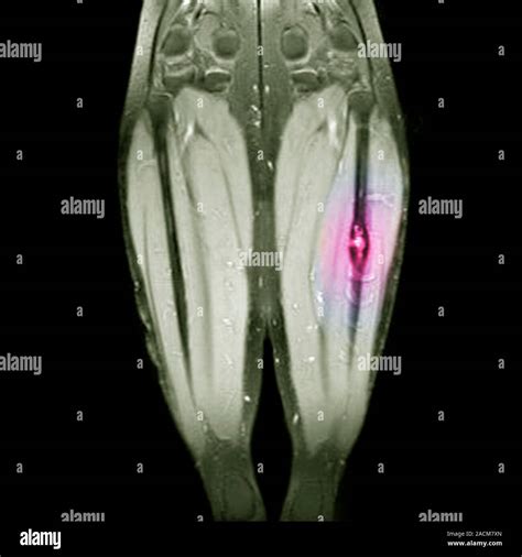 Bone cancer. Coloured magnetic resonance imaging (MRI) scan of the legs of a 46 year old woman ...