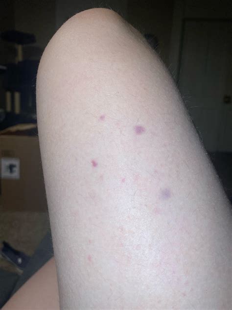 Cluster of tiny bruises? : r/medical