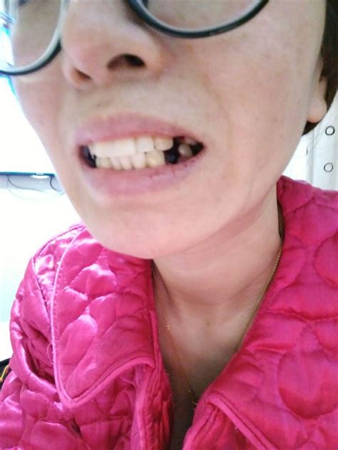 34岁大龄女二次牙齿矫正的经历 - 知乎