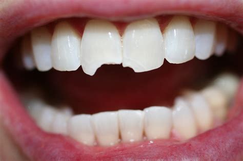 Can You Bruise Your Front Teeth at Jerry Cook blog
