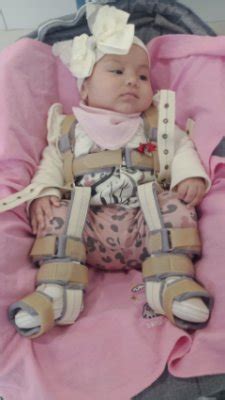 Displasia de cadera | BabyCenter