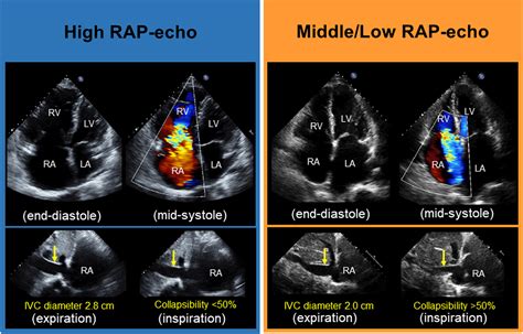 Implication of Right Atrial Pressure Estimated by Echocardiography in Patients with Severe ...
