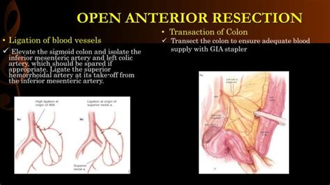 Image result for Open Colon Resection Surgery