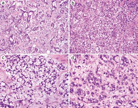 Goblet Cell Adenocarcinoma of the Appendix: Diagnosis, Prognosis and Nomenclature
