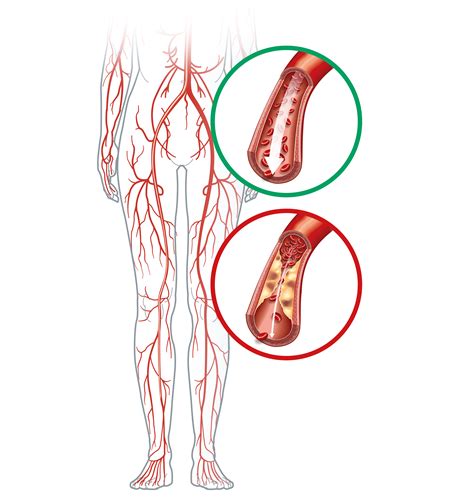 Ways to Treat Peripheral Artery Disease | Pulse Cardiology