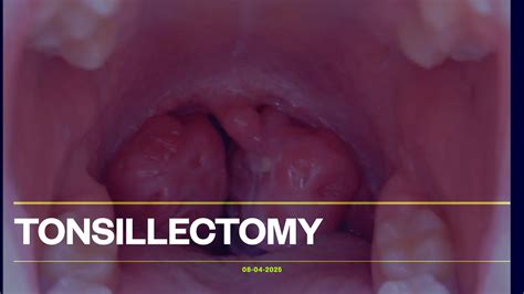Tonsillectomy: Surgical Removal of Tonsils | PPT