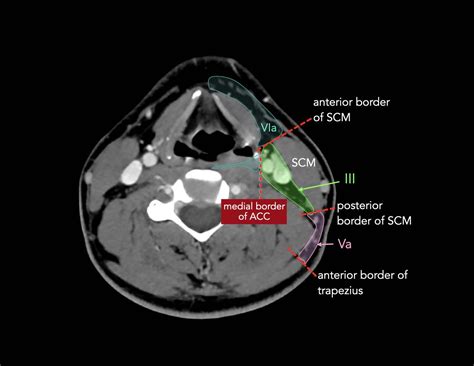 Ct Scan Neck Lymph Nodes - Cervical Lymph Node Levels - IJTKZ