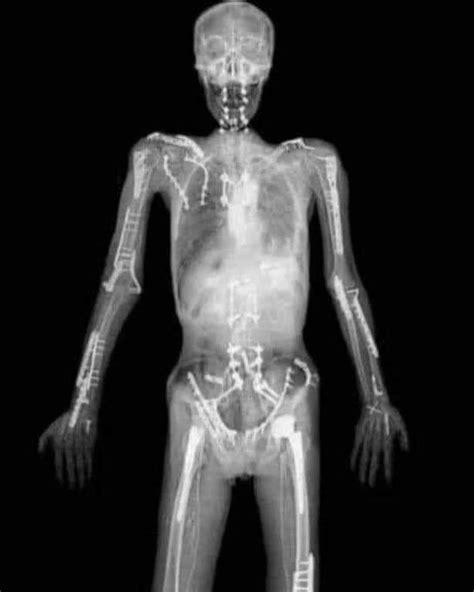 kill—lvrboy | [𓌵2116] The X-Ray of Travis Pastrana — Gold medalist and ...