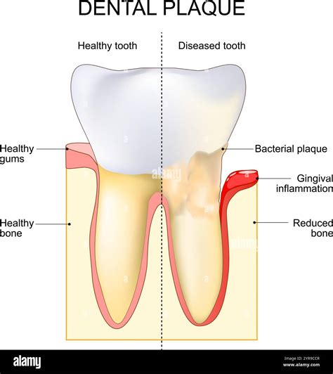 What Is Plaque On Teeth