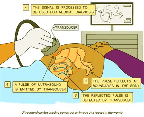 Ultrasound - Physics for GCSE/IGCSE - Year 11 PDF Download