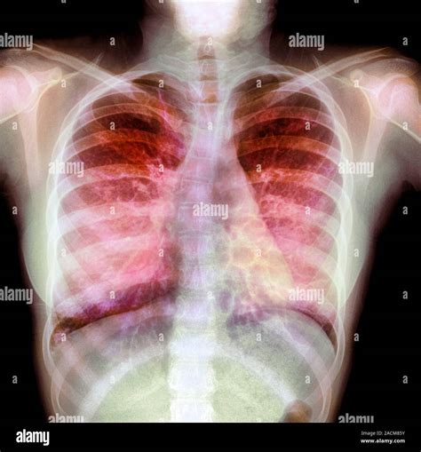 Cystic Fibrosis Lungs Pictures, Images And Stock Photos – YLEAV